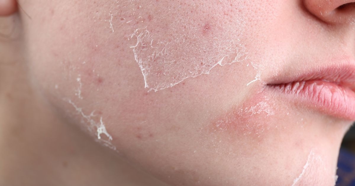 what-causes-extremely-dry-skin 